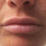 Fillers Before & After Patient #2111