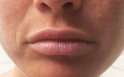 Fillers Before & After Patient #2111
