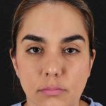 Browlift Before & After Patient #1341