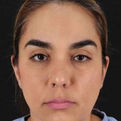 Browlift Before & After Patient #1341