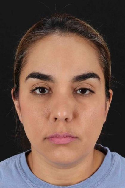 Browlift Before & After Patient #1341