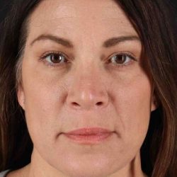 Lip Lift Before & After Patient #2133