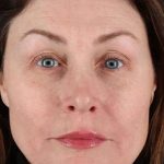 Lip Lift Before & After Patient #2144