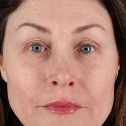 Lip Lift Before & After Patient #2144