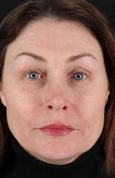 Lip Lift Before & After Patient #2144