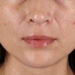 Lip Lift Before & After Patient #2166