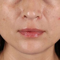 Lip Lift Before & After Patient #2166