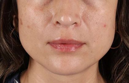 Lip Lift Before & After Patient #2166