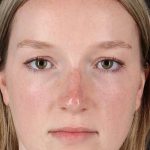 Liquid Rhinoplasty Before & After Patient #2177