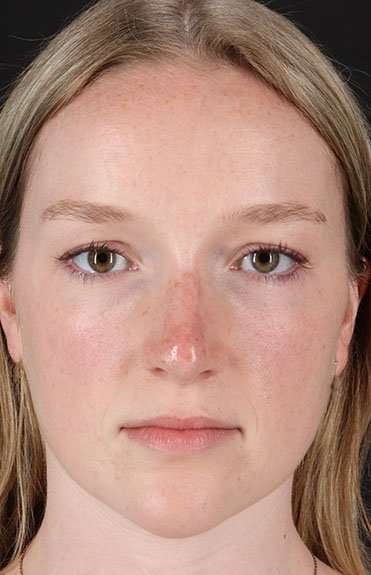 Liquid Rhinoplasty Before & After Patient #2177