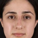 Liquid Rhinoplasty Before & After Patient #2188
