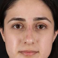 Liquid Rhinoplasty Before & After Patient #2188