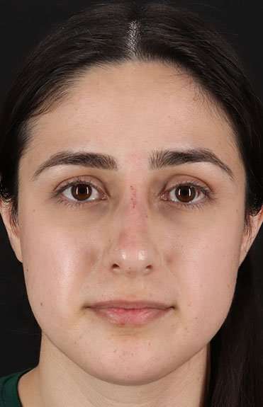 Liquid Rhinoplasty Before & After Patient #2188
