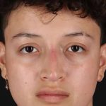 Liquid Rhinoplasty Before & After Patient #2199