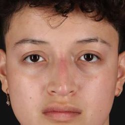 Liquid Rhinoplasty Before & After Patient #2199