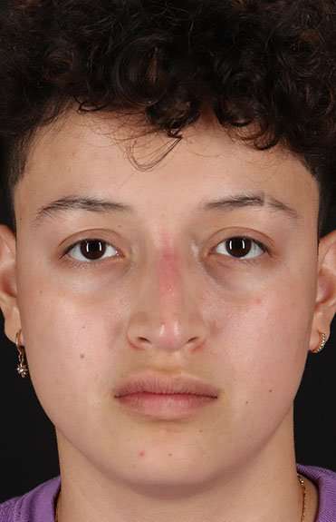 Liquid Rhinoplasty Before & After Patient #2199