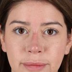 Liquid Rhinoplasty Before & After Patient #2210