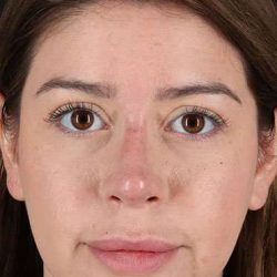 Liquid Rhinoplasty Before & After Patient #2210