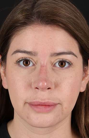 Liquid Rhinoplasty Before & After Patient #2210
