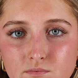 Liquid Rhinoplasty Before & After Patient #2221