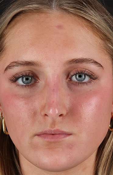 Liquid Rhinoplasty Before & After Patient #2221
