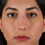 Liquid Rhinoplasty Before & After Patient #2232