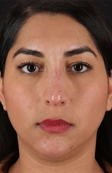 Liquid Rhinoplasty Before & After Patient #2232