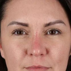 Liquid Rhinoplasty Before & After Patient #2243