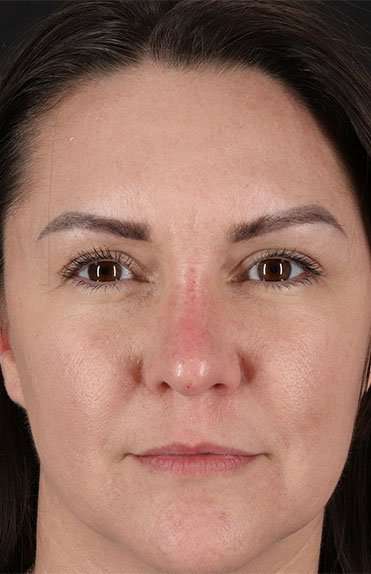 Liquid Rhinoplasty Before & After Patient #2243