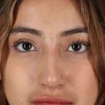 Liquid Rhinoplasty Before & After Patient #2254