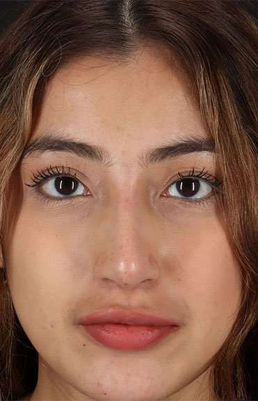 Liquid Rhinoplasty Before & After Patient #2254