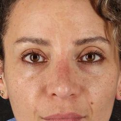 Liquid Rhinoplasty Before & After Patient #2276