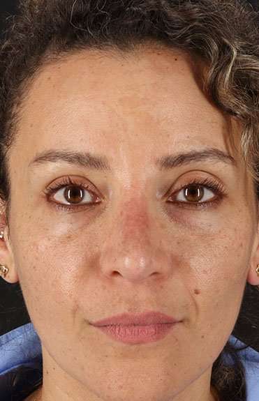 Liquid Rhinoplasty Before & After Patient #2276
