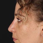 Liquid Rhinoplasty Before & After Patient #2279
