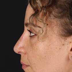 Liquid Rhinoplasty Before & After Patient #2279