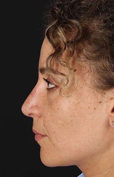 Liquid Rhinoplasty Before & After Patient #2279