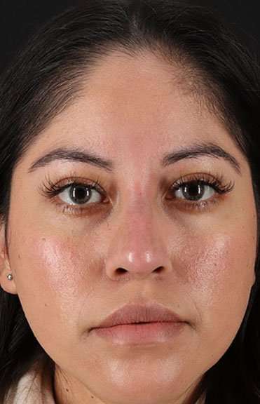 Liquid Rhinoplasty Before & After Patient #2290