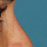 Liquid Rhinoplasty Before & After Patient #2299