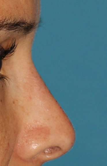 Liquid Rhinoplasty Before & After Patient #2299