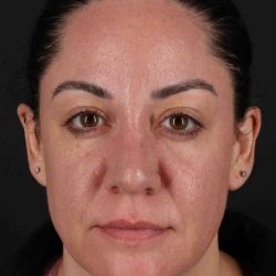 Browlift Before & After Patient #1363