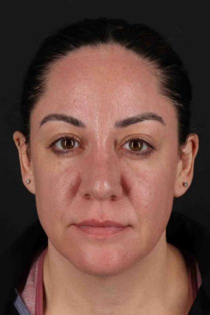 Browlift Before & After Patient #1363