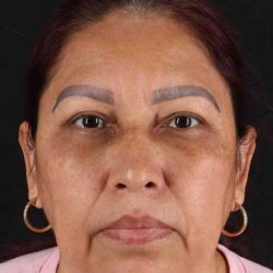 Lower Blepharoplasty Before & After Patient #2321