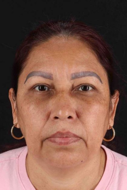 Lower Blepharoplasty Before & After Patient #2321