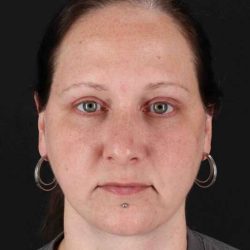 Lower Blepharoplasty Before & After Patient #2354