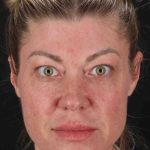 Lower Blepharoplasty Before & After Patient #2387