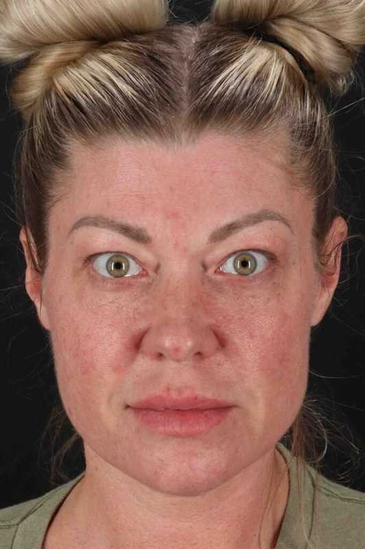 Lower Blepharoplasty Before & After Patient #2387