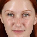 Lower Blepharoplasty Before & After Patient #2409