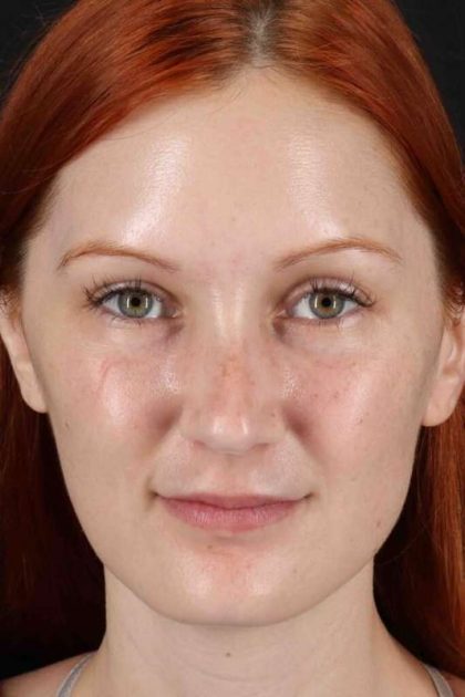 Lower Blepharoplasty Before & After Patient #2409