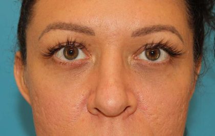 Browlift Before & After Patient #1366