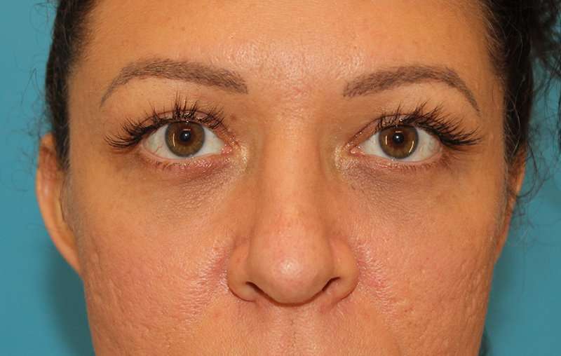 Browlift Before & After Patient #1366